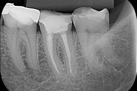 Controle Radiográfico após 17 meses