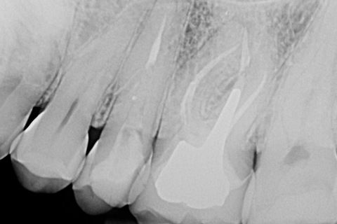 Radiografia de controle de 13 meses evidenciando normalidade dos tecidos perirradiculares com restauração final em posição.
