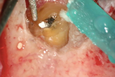 Remoção Cirúrgica do Cone de Prata