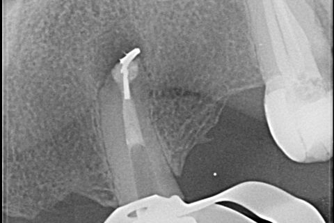 Obturação Endodôntica