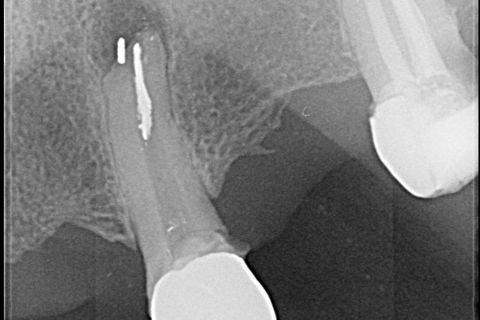 Primeira Separação do Cone de Prata