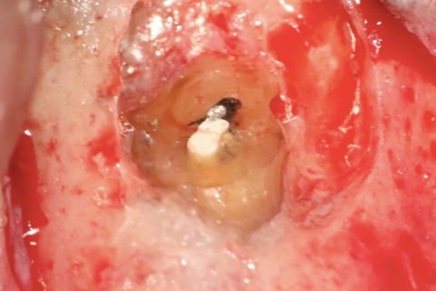 Terço apical após apicectomia