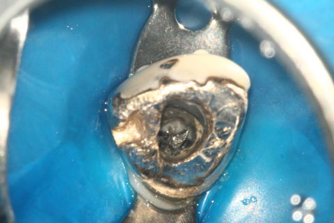 Vista do canal obturado da parte coronária do Cone de Prata