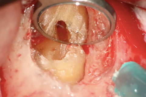 Preparação Retrógrada