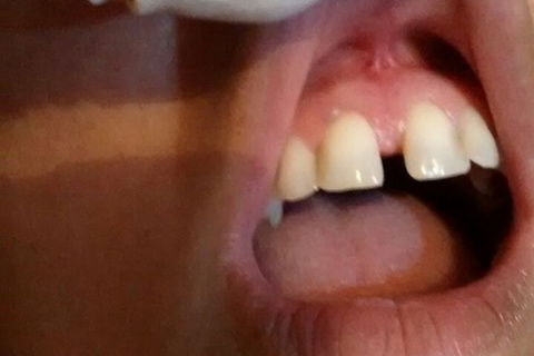 Aspecto final (30 dias após o procedimento)