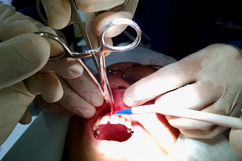 Tesoura reta sobre e paralela à pinça hemostática