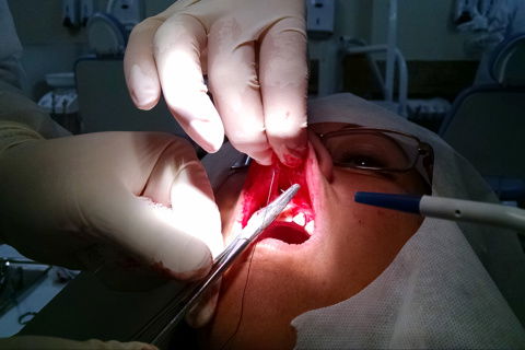 Sutura com fio de seda 4-0