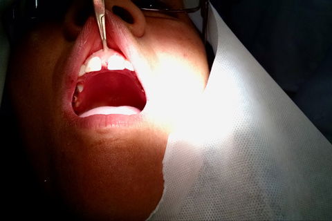 Apreensão do freio com Pinça Hemostática (Mosquito curva)