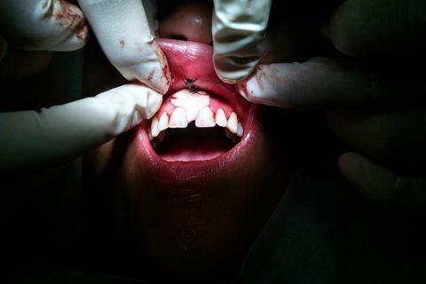 Utilização de cimento cirúrgico (PerioBond)