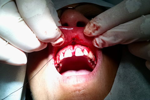 Distribuição dos pontos de sutura