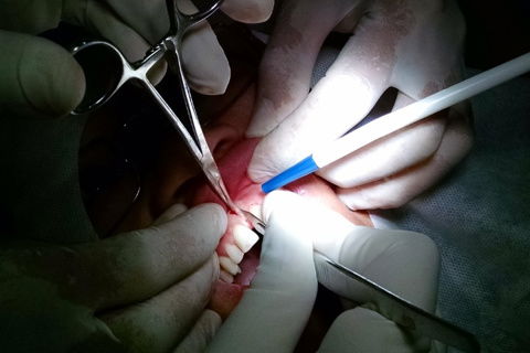 Frenectomia Labial Superior