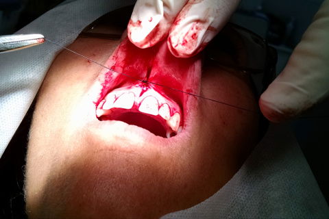 Sutura inicial no ponto central da incisão cirúrgica