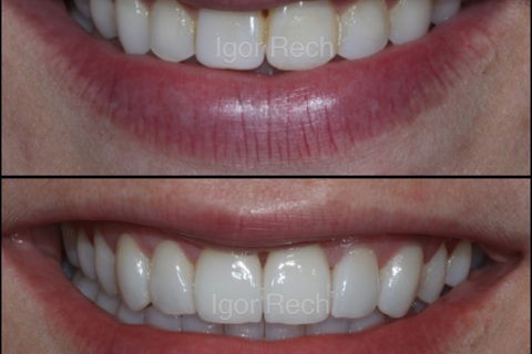 Substituição de Duas Facetas em Resina Composta 11-21 (Susbtrato Escurecido) e Acréscimo de 6 Novas Lentes de Contato