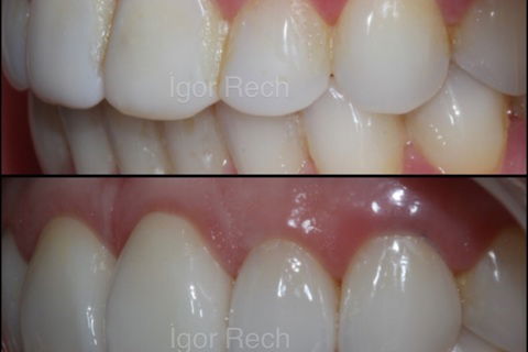 Substituição de Duas Facetas em Resina Composta 11-21 (Susbtrato Escurecido) e Acréscimo de 6 Novas Lentes de Contato