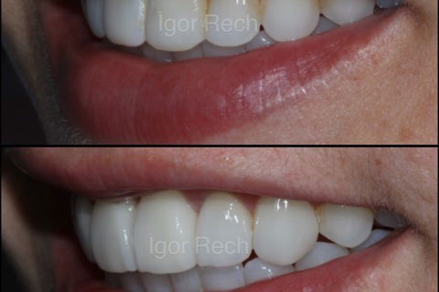 Substituição de Duas Facetas em Resina Composta 11-21 (Susbtrato Escurecido) e Acréscimo de 6 Novas Lentes de Contato