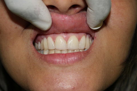 Facetas Estéticas em Resina Composta + Adesiva em Paciente com Agenesia de Incisivos Laterais