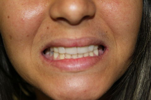 Facetas Estéticas em Resina Composta + Adesiva em Paciente com Agenesia de Incisivos Laterais