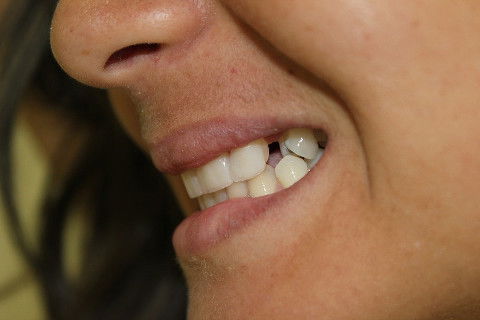 Facetas Estéticas em Resina Composta + Adesiva em Paciente com Agenesia de Incisivos Laterais