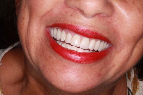 Cirurgia Guiada - Protocolo de Mandíbula Sem Cortes, Sem Pontos, Sem Sangue.