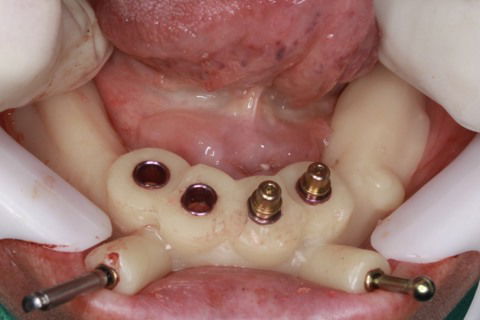 Instalação da guia cirúrgica