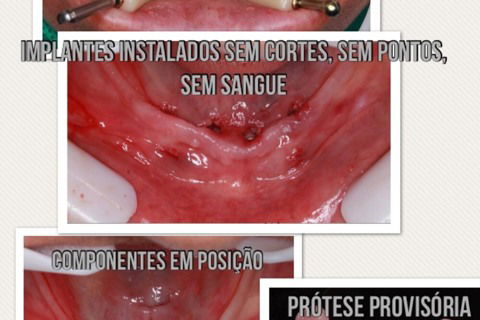 Cirurgia Guiada - Protocolo de Mandíbula Sem Cortes, Sem Pontos, Sem Sangue.