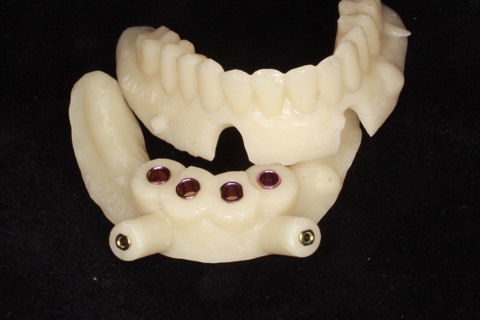 Guia cirúrgica confeccionado na impressora 3D