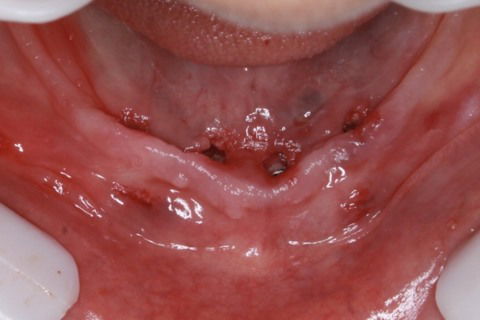 Implantes instalados, sem cortes, sem pontos, sem sangue.