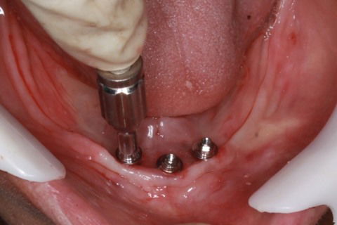 Instalação dos componentes protéticos