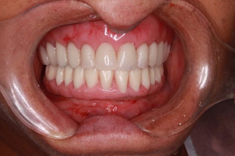 Prótese parafusara logo após a cirurgia