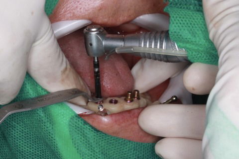 Cirurgia Guiada - Protocolo de Mandíbula Sem Cortes, Sem Pontos, Sem Sangue.