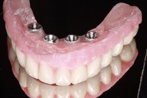 Cirurgia Guiada - Protocolo de Mandíbula Sem Cortes, Sem Pontos, Sem Sangue.