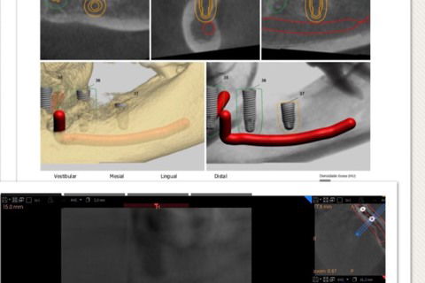 Planejamento virtual e tomografia final