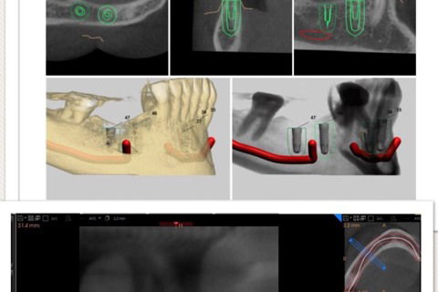 Planejamento virtual e tomografia final