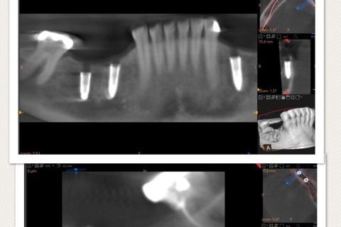 tomografia final comprovando quês técnica é segura e precisa
