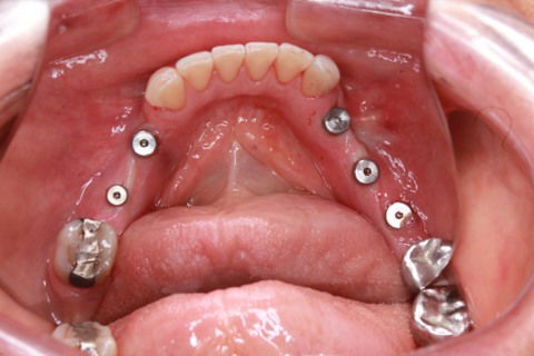 Cicatrizadores em posição