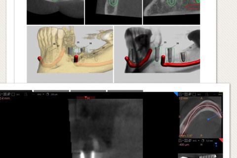 Planejamento virtual e tomografia final