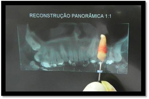 Exodontia do 23 Incluso