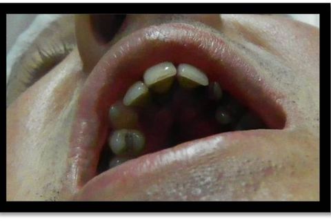 Exodontia do 23 Incluso