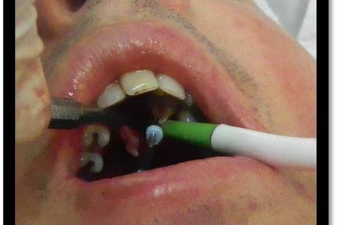 Exodontia do 23 Incluso