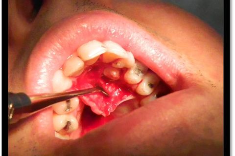 Exodontia do 23 Incluso