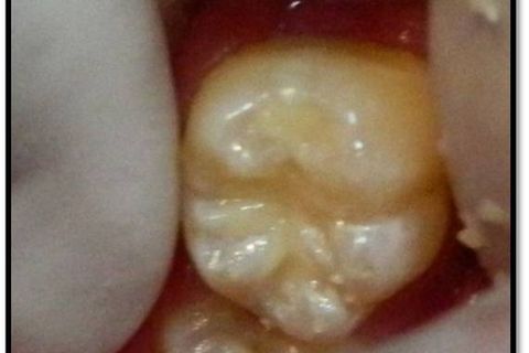 Classe I Perfeitas, Sem Ajustes Oclusais em Minutos