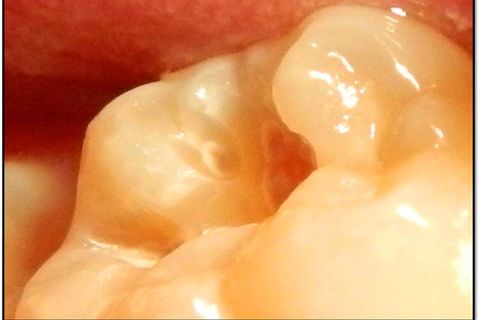 Classe I Perfeitas, Sem Ajustes Oclusais em Minutos