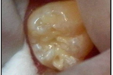 Na última camada coloque material suficiente para cobrir os preparos