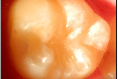 Visão final do caso sem flash