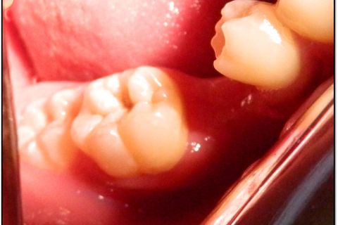 Lesão cariosa detectada no exame clínico e radiográfico