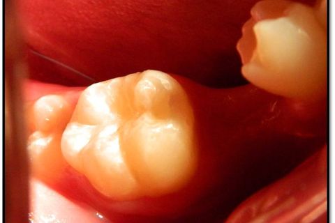 Vista oclusal após polimento