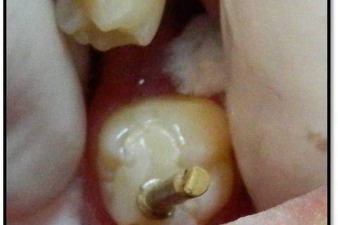 Classe I Perfeitas, Sem Ajustes Oclusais em Minutos