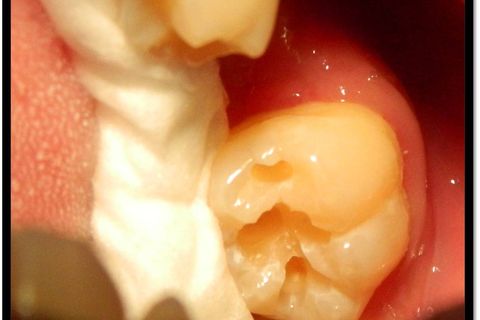 Classe I Perfeitas, Sem Ajustes Oclusais em Minutos