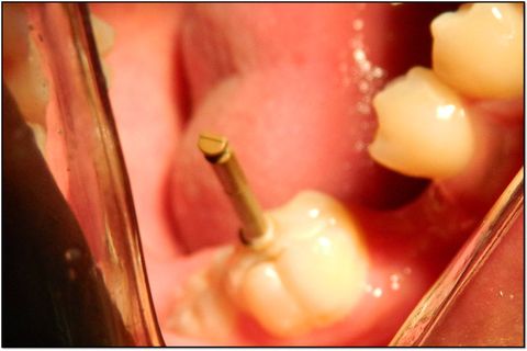 Após use a peça para imprimir, carimbar a face oclusal