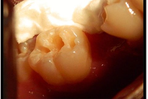 Classe I Perfeitas, Sem Ajustes Oclusais em Minutos